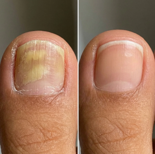 Fungus Eliminator -La solución natural para uñas con hongos con envío gratis 🎁