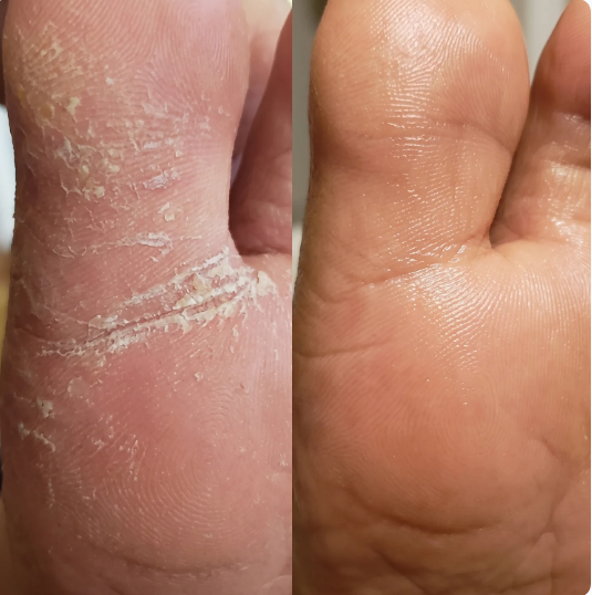 Fungus Eliminator -La solución natural para uñas con hongos con envío gratis 🎁