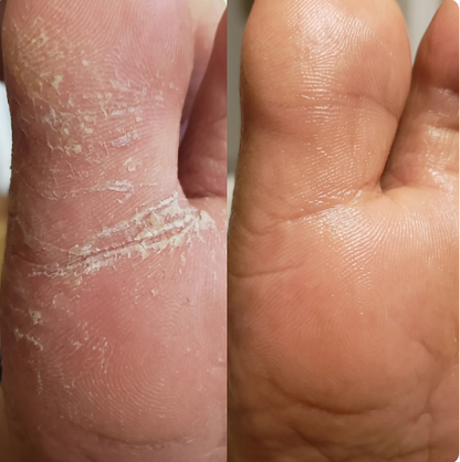Fungus Eliminator -La solución natural para uñas con hongos con envío gratis 🎁