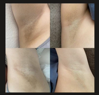 Crema Carotone/ Ayuda a mejorar la apariencia de manchas y zonas oscuras de tu piel, con envío gratis
