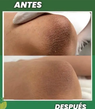 Crema Carotone/ Ayuda a mejorar la apariencia de manchas y zonas oscuras de tu piel, con envío gratis